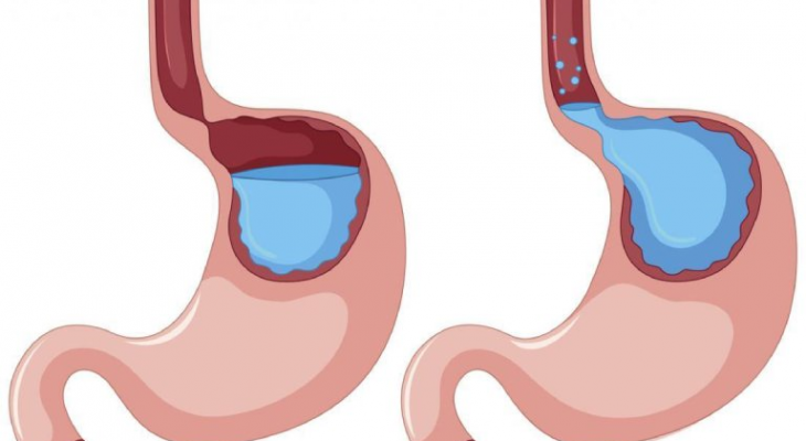 PHIẾU TÓM TẮT THÔNG TIN ĐIỀU TRỊ  BỆNH TRÀO NGƯỢC THỰC QUẢN- DẠ DÀY.