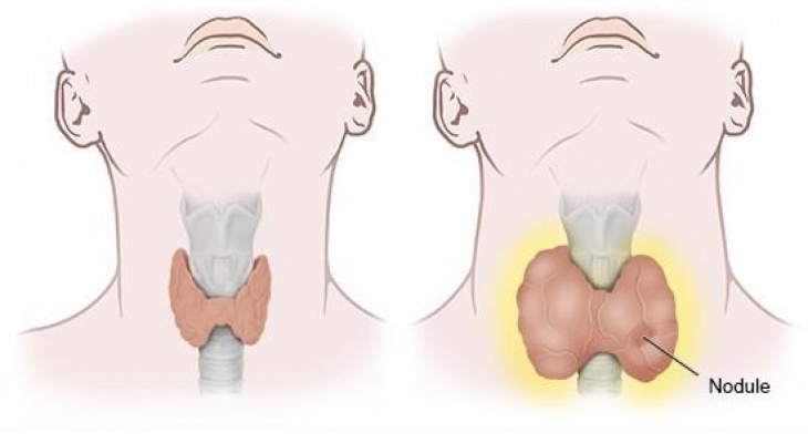 PHIẾU TÓM TẮT THÔNG TIN ĐIỀU TRỊ BỆNH CƯỜNG GIÁP.