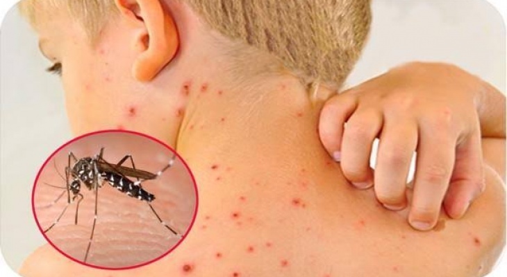SỐT XUẤT HUYẾT KHÔNG CHỪA MỘT AI.