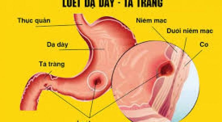 PHIẾU TÓM TẮT THÔNG TIN ĐIỀU TRỊ  BỆNH LOÉT DẠ DÀY TÁ TRÀNG.