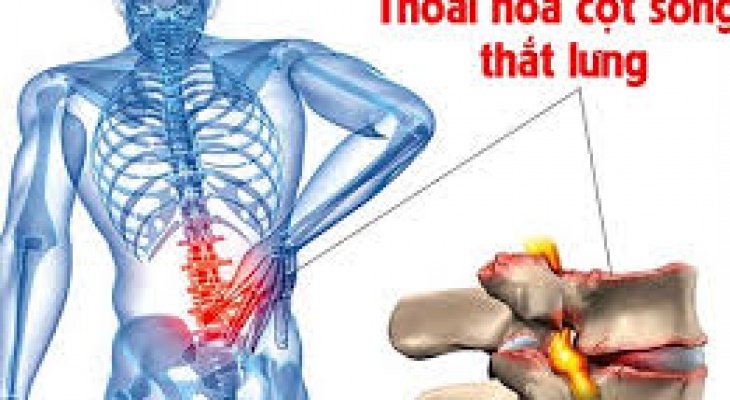 PHIẾU TÓM TẮT THÔNG TIN ĐIỀU TRỊ BỆNH THOÁI HOÁ CỘT SỐNG.